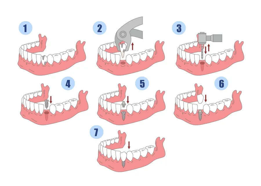 Dental implant treatment explained step by step