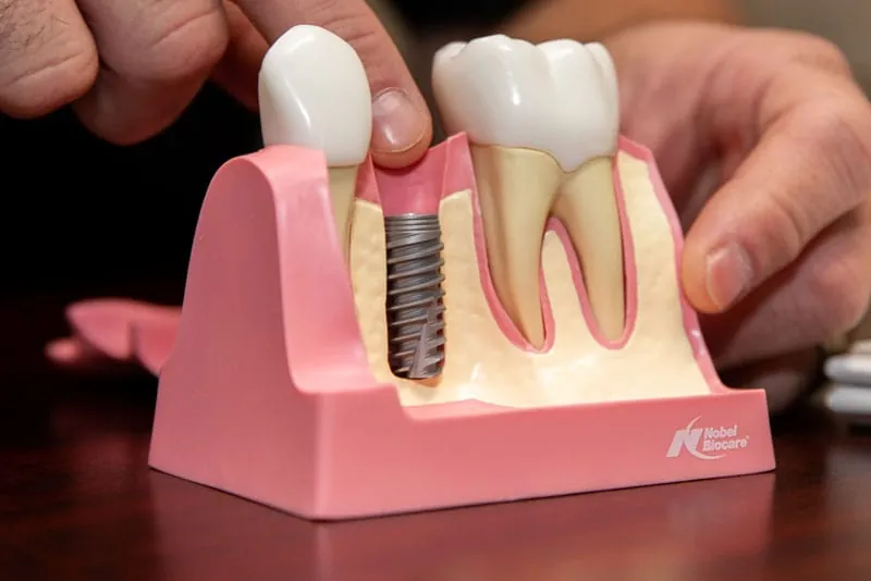 Implant treatment carried out in a dental clinic