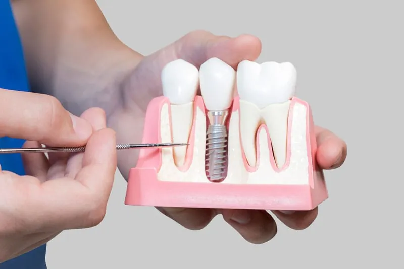 Restorative dental implant components used in treatment