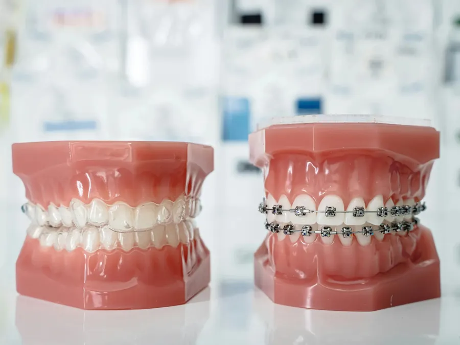 Clear aligner orthodontic treatment