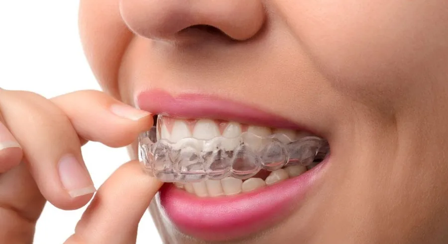 Orthodontic braces used for tooth alignment