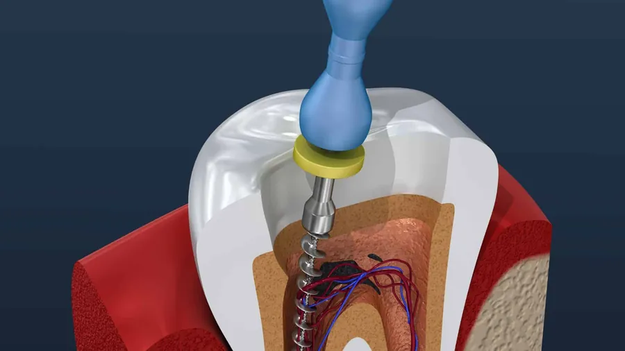 Root canal treatment being carried out in a modern dental clinic