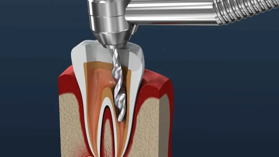 Endodontic root canal treatment in a dental clinic