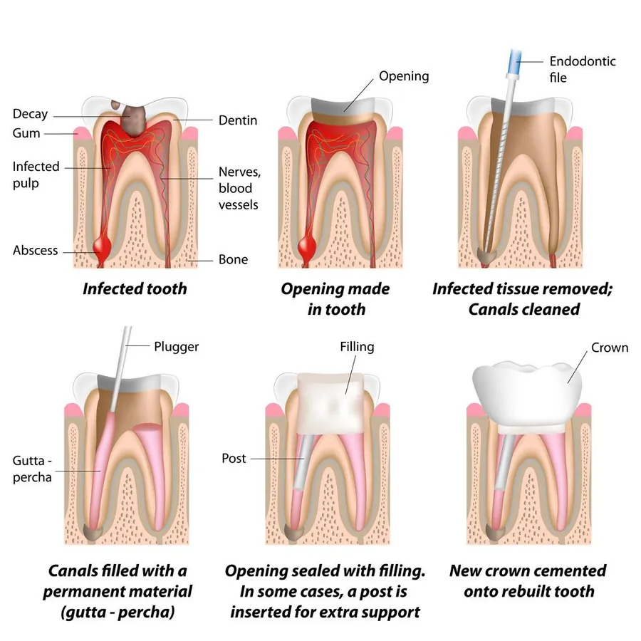 Root canal therapy equipment used in a clinical setting
