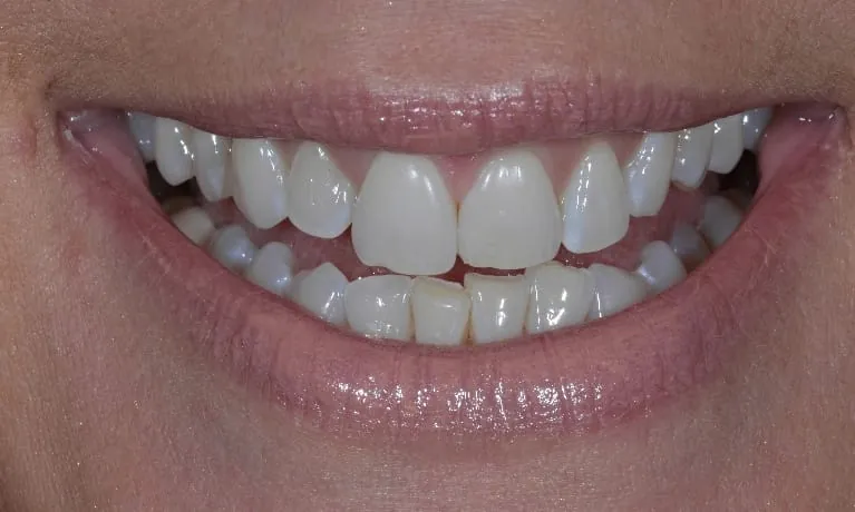 Smile restoration with porcelain veneers
